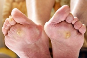 BUNION – What to know about this painful condition